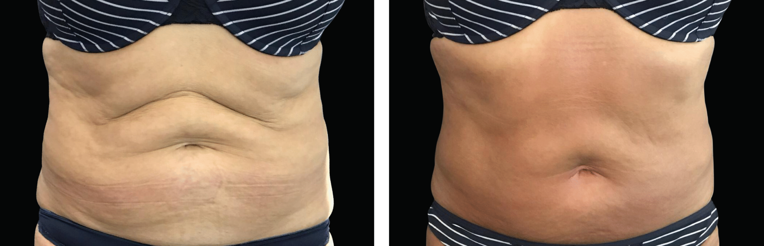 Exilis Ultra 360 преди и след — корем