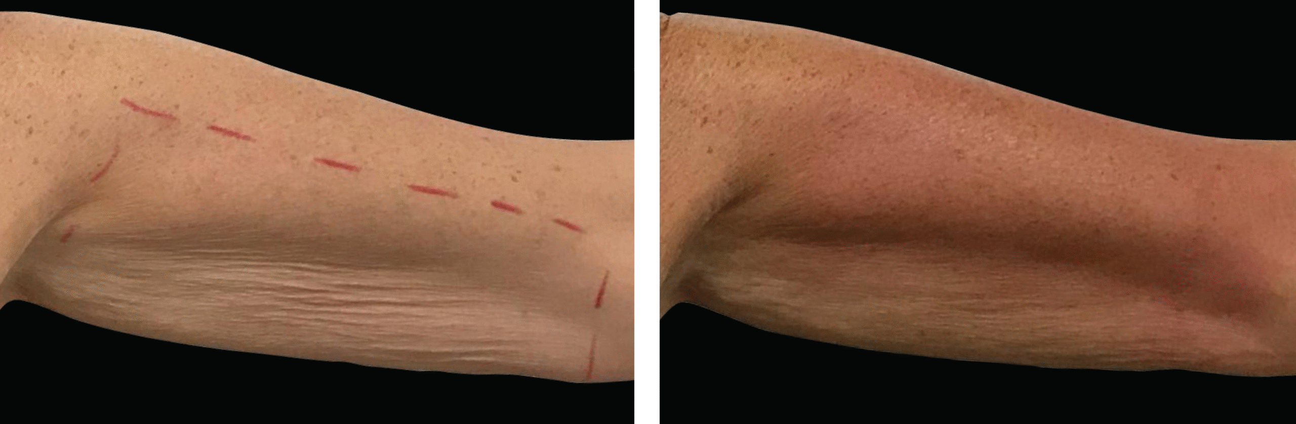 Exilis Ultra 360 преди и след — ръце