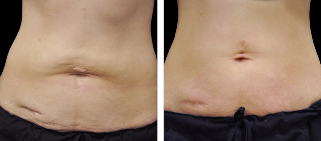 Оформяне и стягане на тялото с Exilis Ultra 360 в Skin Vision София